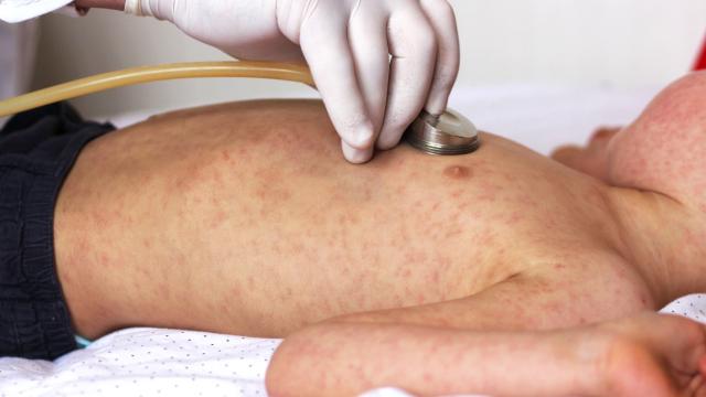 Un niño con sarampión.