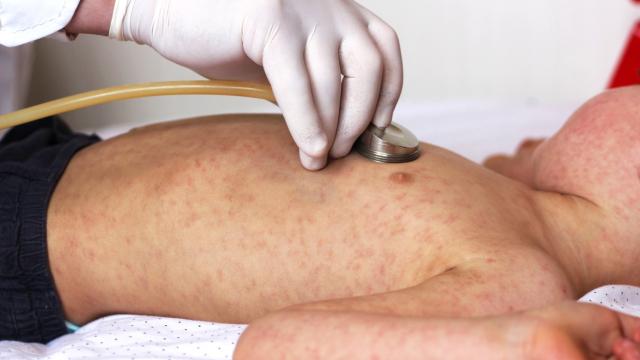 Un niño con sarampión.