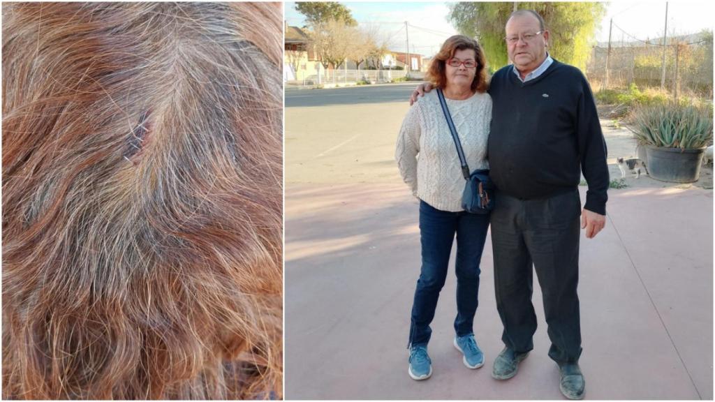 Rosario, víctima de la 'banda de la caca de la paloma', posando junto a su esposo, Miguel. Al lado, una imagen de las grapas que le pusieron en la cabeza a la mujer tras sufrir el robo.