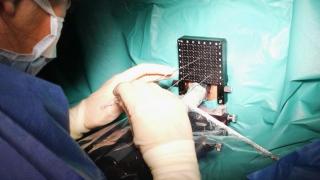 Un+momento+del+procedimiento+de+braquiterapia