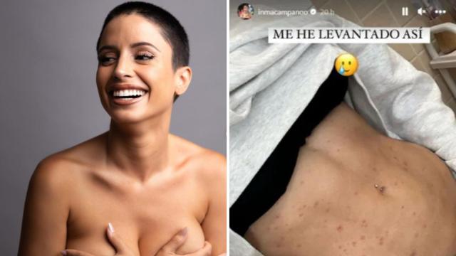 La 'influencer' Inma Campano ingresada en el hospital por tres enfermedades a la vez: sarna, gripe A y escarlatina