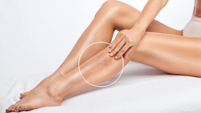 Una mujer con varices en la consulta.