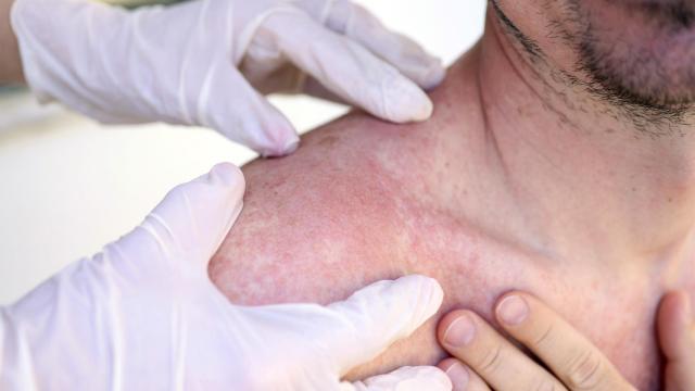 En 2023 se diagnosticaron 3.377 casos de melanoma maligno cutáneo en hombres.