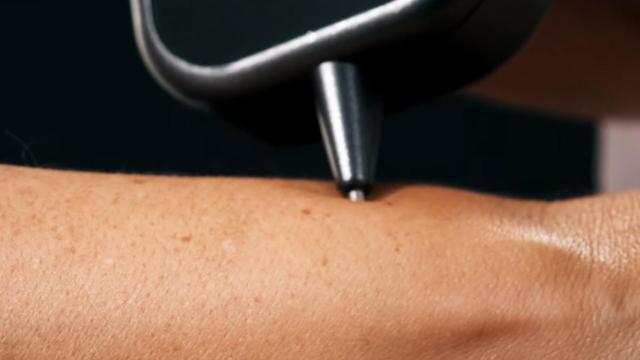 Análisis de una lesión cutánea con DermaSensor
