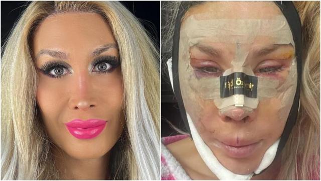 La Pelopony, antes y después de sus seis operaciones.