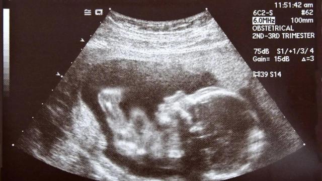 El TEAF también dificulta la creación de un vínculo seguro.