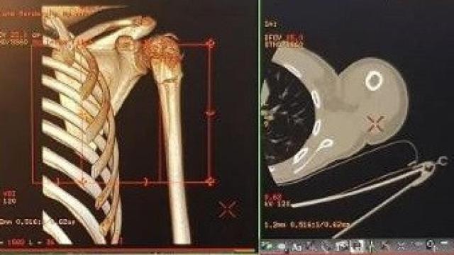 Imágenes tridimensionales realizadas por un TAC, invento del Nobel Allan Cormack