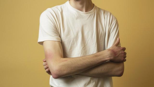 Los hematomas son difíciles de prevenir, pero no de curar