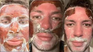 Un 'tiktoker' muestra el proceso de recuperación tras un 'peeling' profundo de fenol.