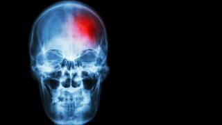 Imagen de un ictus cerebral. Europa Press