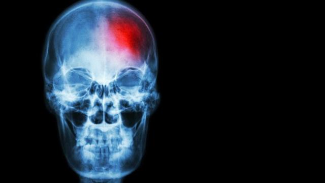 Imagen de un ictus cerebral.