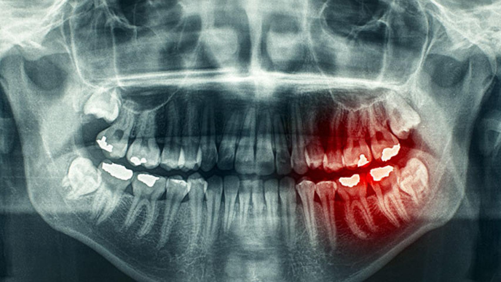 Radiografía de la zona bucal.