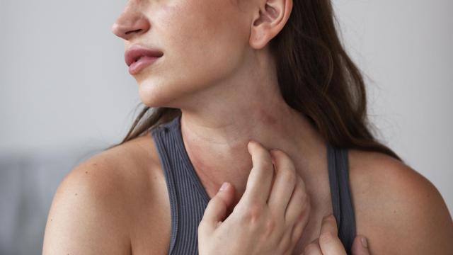 La psoriasis afecta a un 2% de las personas.