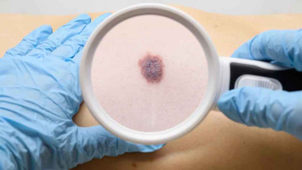 El diagnóstico del melanoma ha mejorado en los últimos años.