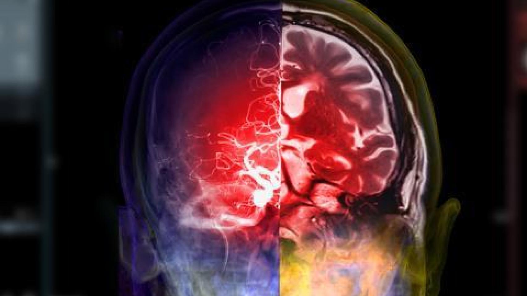 La acumulación de placas amiloides en el cerebro de las personas con alzhéimer ya se conocía cuando se describió la enfermedad.
