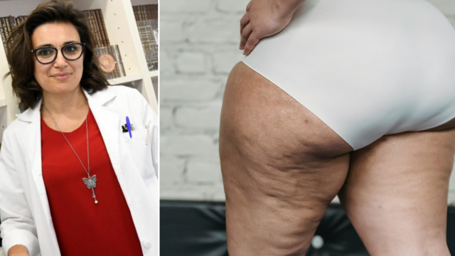 La doctora Carmen Iglesias (EFE/Víctor Lerena) / Lipedema (Pexels/Julia Larson)