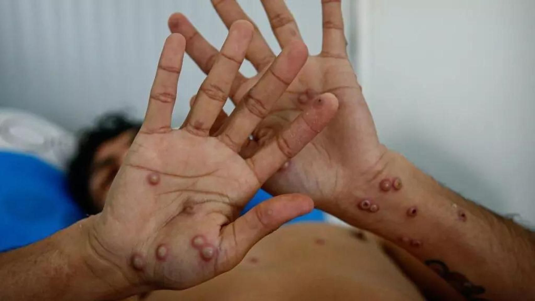Un paciente muestras las heridas provocadas por la mpox.