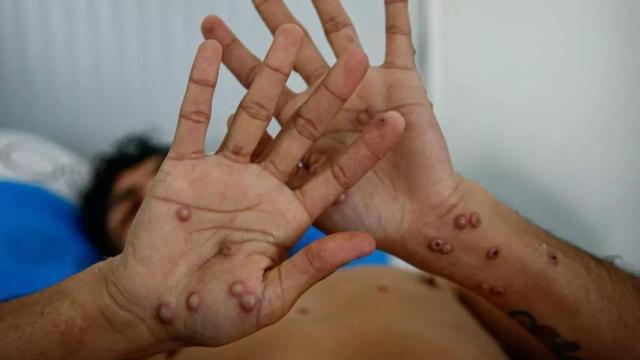 Un paciente muestras las heridas provocadas por la viruela del mono.