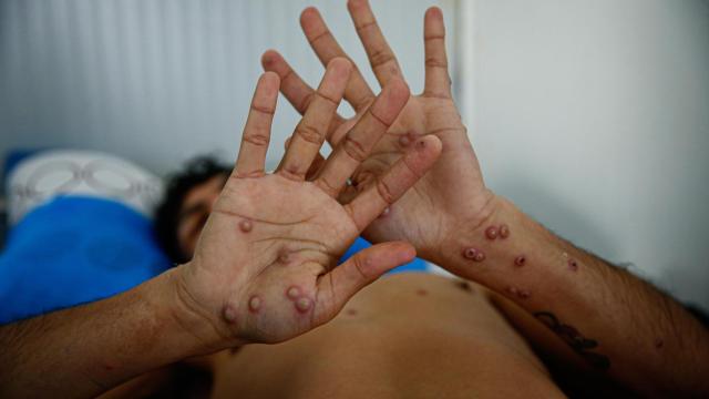 Un paciente muestras las heridas provocadas por la mpox.