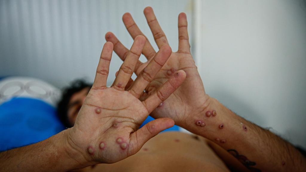 Un paciente muestras las heridas provocadas por la mpox.