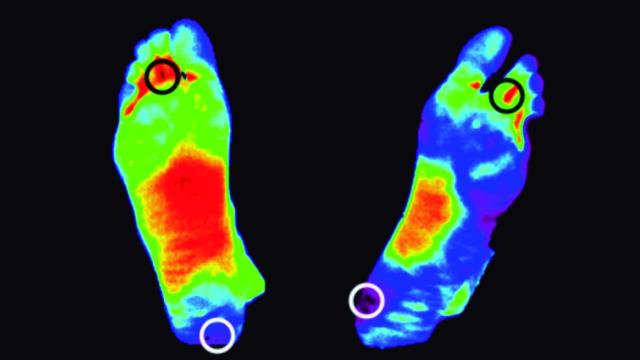 Prevención de pie diabético con termografía.