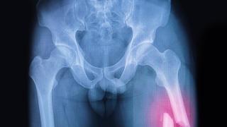 Radiografía de una fractura de fémur.