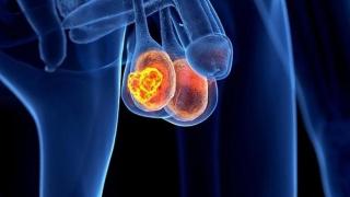 Representación de un cáncer de testículos.