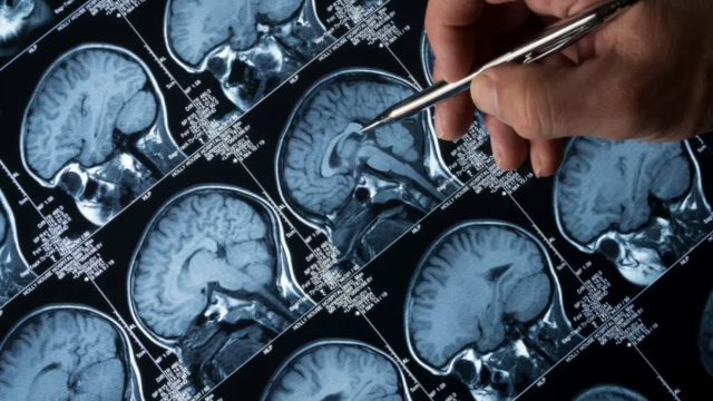 Una de cada cinco personas con epilepsia padece depresión o ansiedad, pudiendo afectar al tratamiento