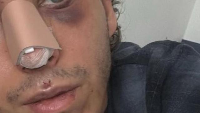 La cara de Manuel, víctima de una  brutal agresión homófoba en Valencia. EE