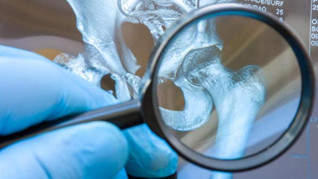 Imagen de archivo de un médico examinando una radiografía de una cadera.