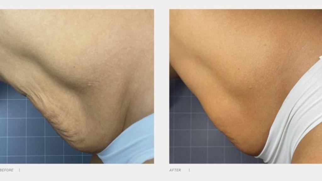 Antes y después del tratamiento HERA.