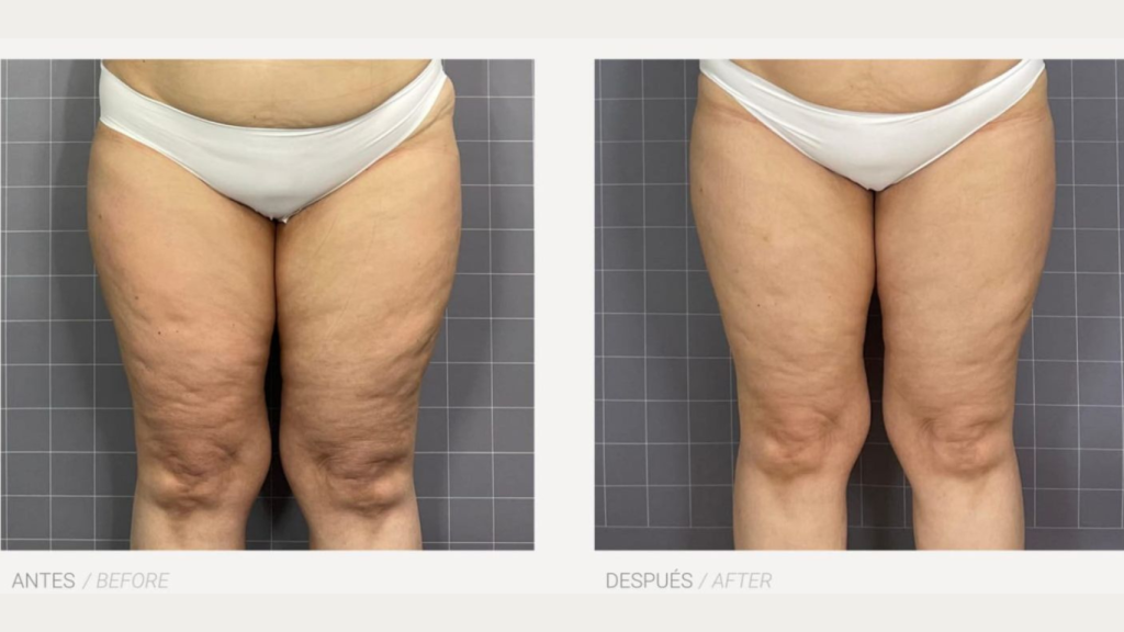 Antes y después del tratamiento HERA.