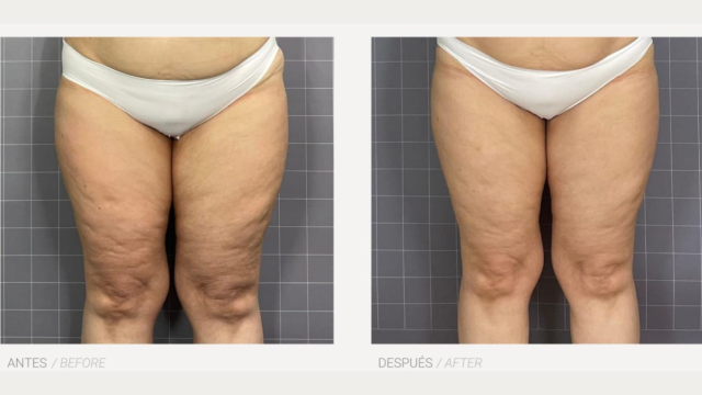 Antes y después del tratamiento HERA.