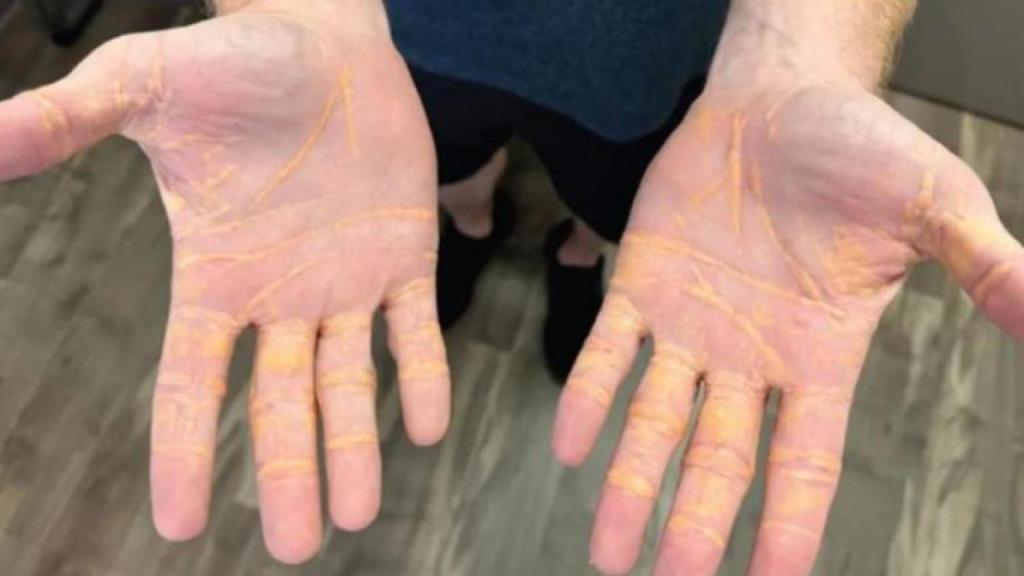 Imagen colesterol fitrado en las manos