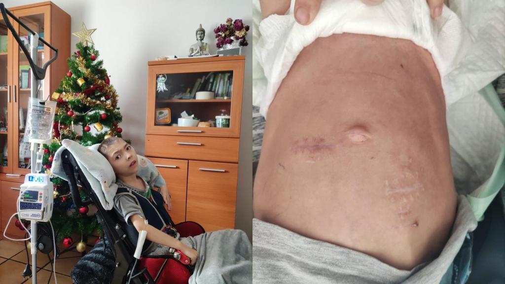 Javier se tenía que alimentar con una sonda nasogástrica.