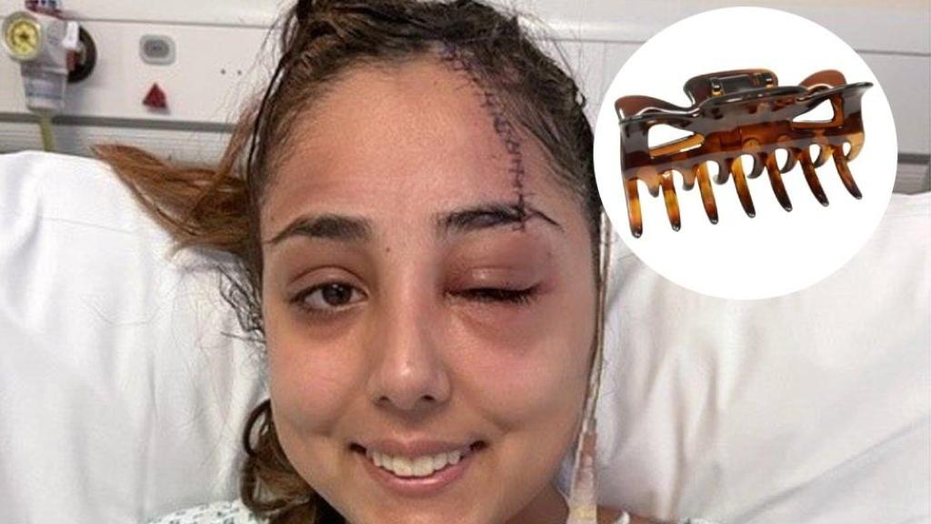 Jeena Panesar, superviviente de un accidente de tráfico en el que se clavó su pinza del pelo en el cráneo.