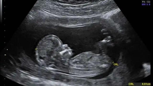 La madre tomaba el medicamento que le llegaba al feto a través de la placenta.