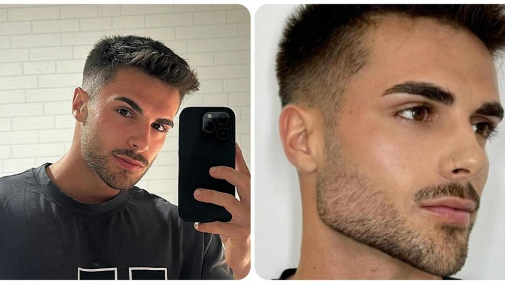 Joel Benedicto, antes y después del tratamiento de mandíbula.