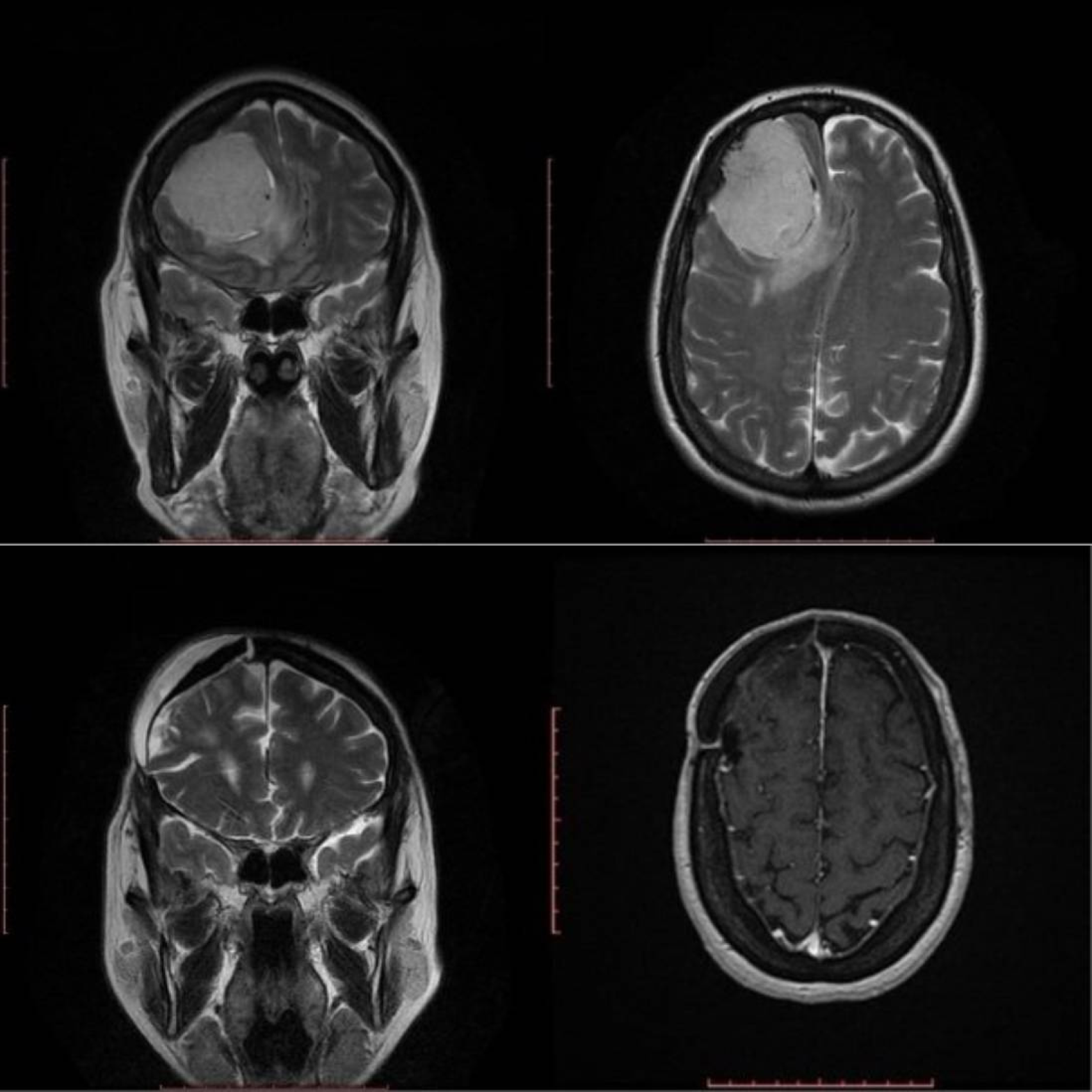 Imagen de una lesión tumoral antes y después de la cirugía.