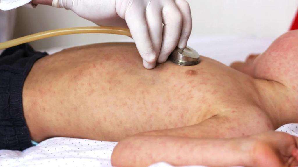 Imagen de archivo de un niño con sarampión siendo auscultado.