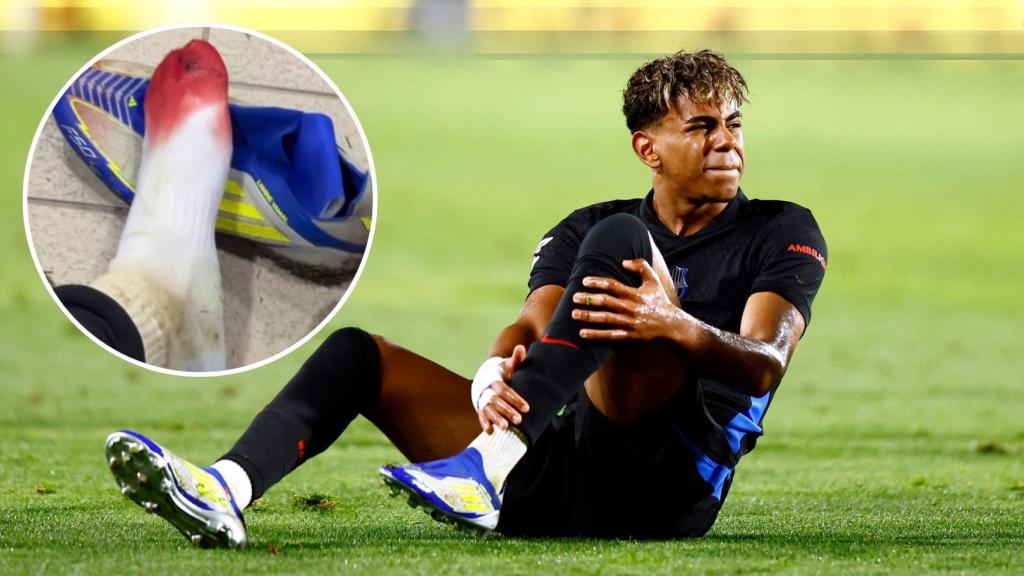 Lamine Yamal y la herida en el pie que sufrió contra Las Palmas