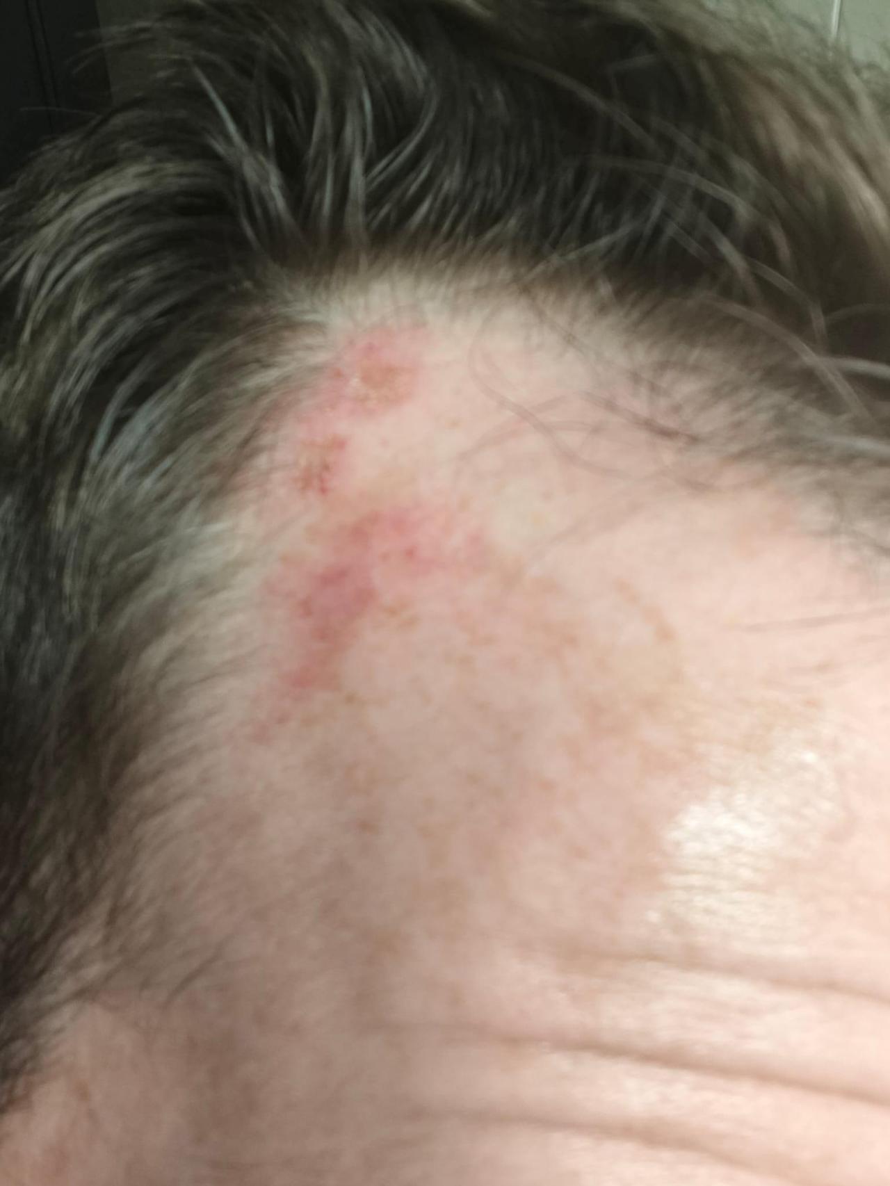 Un moratón que Juanjo lucía en la cabeza tras recibir la paliza en el campo de fútbol de Alguazas.