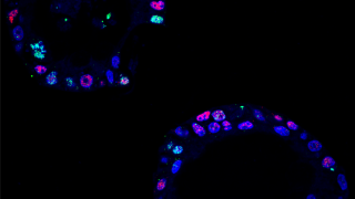 Golpe al cáncer de páncreas: descubren los círculos secretos de ADN que alimentan la agresividad del tumor
