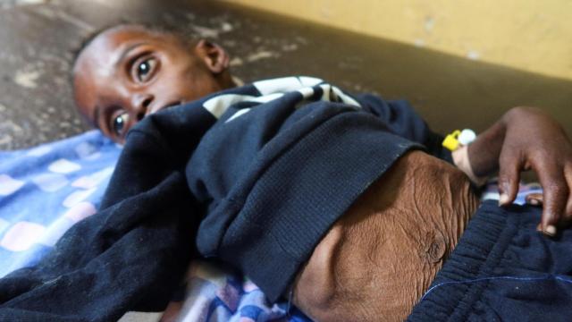 Un niño desnutrido, el pasado sábado, en el hospital Alban Jadeed de Jartum, Sudán.