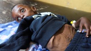 Un niño desnutrido, el pasado sábado, en el hospital Alban Jadeed de Jartum, Sudán.