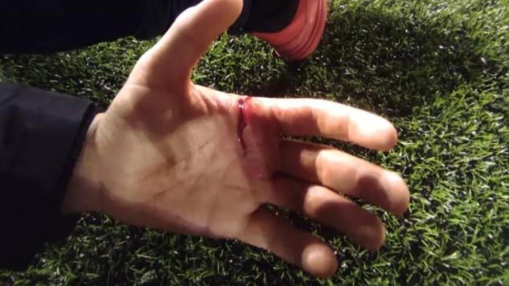 La herida de la mano del entrenador agredido.