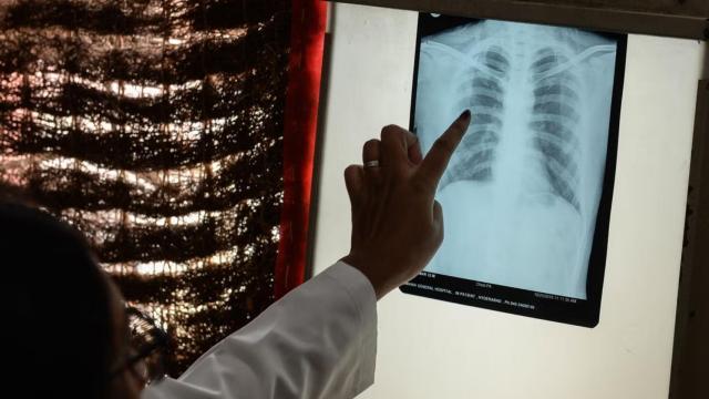 Imagen de archivo de un médico revisando la radiografía de tórax de un paciente.