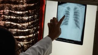 Imagen de archivo de un médico revisando la radiografía de tórax de un paciente.