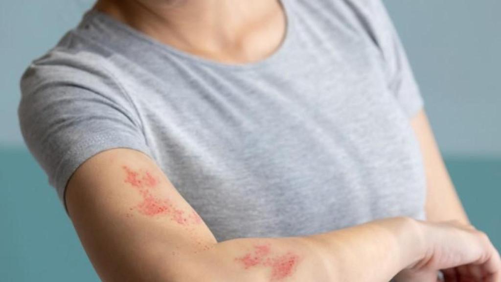 El herpes zóster o 'culebrilla' se reactiva en forma de erupción cutánea.