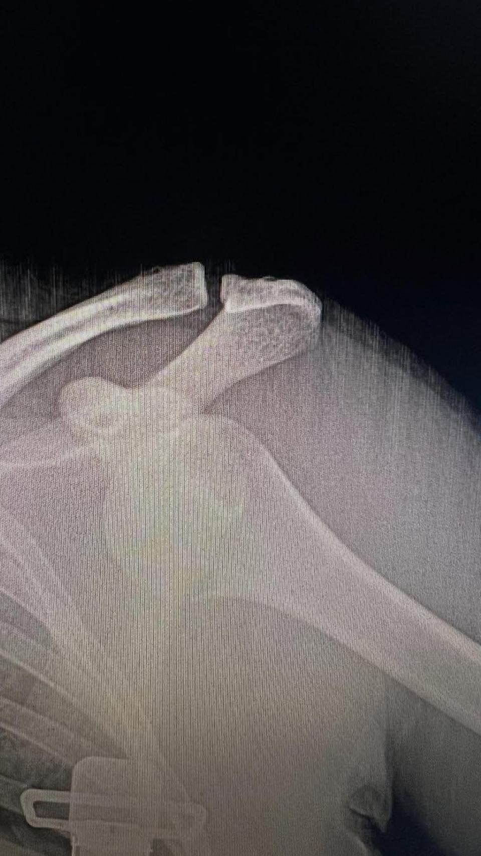 El político ha compartido en su perfil de Instagram una radiografía de su hombro, que ya está recuperado.